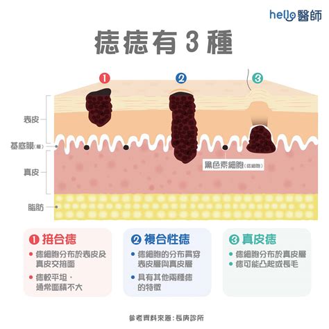 接合痣|為什麼臉上的痣越來越多？皮膚科醫師解析長痣原因、。